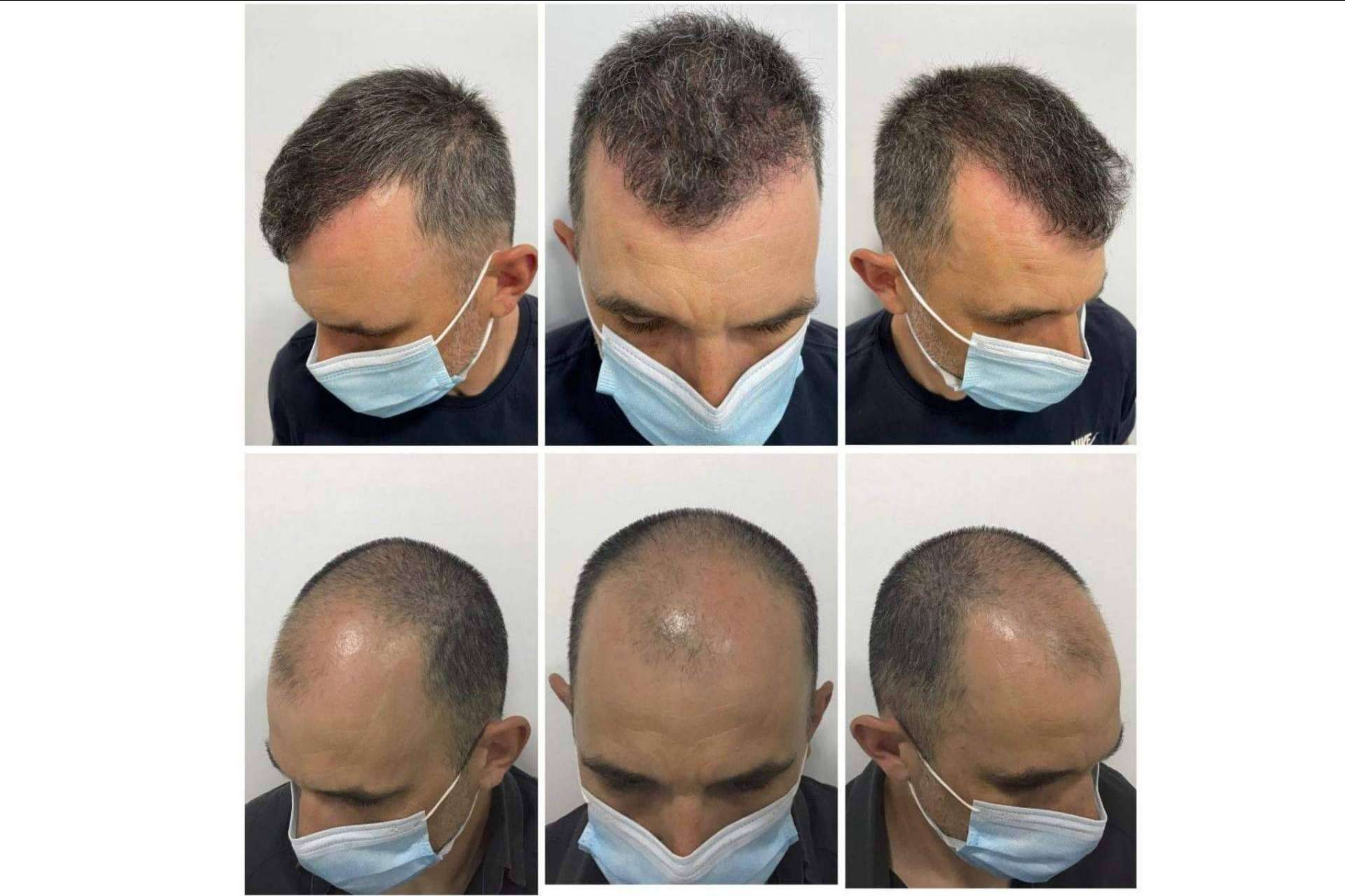 Tratamiento de mesoterapia capilar del Dr. Bruno Jacobovski