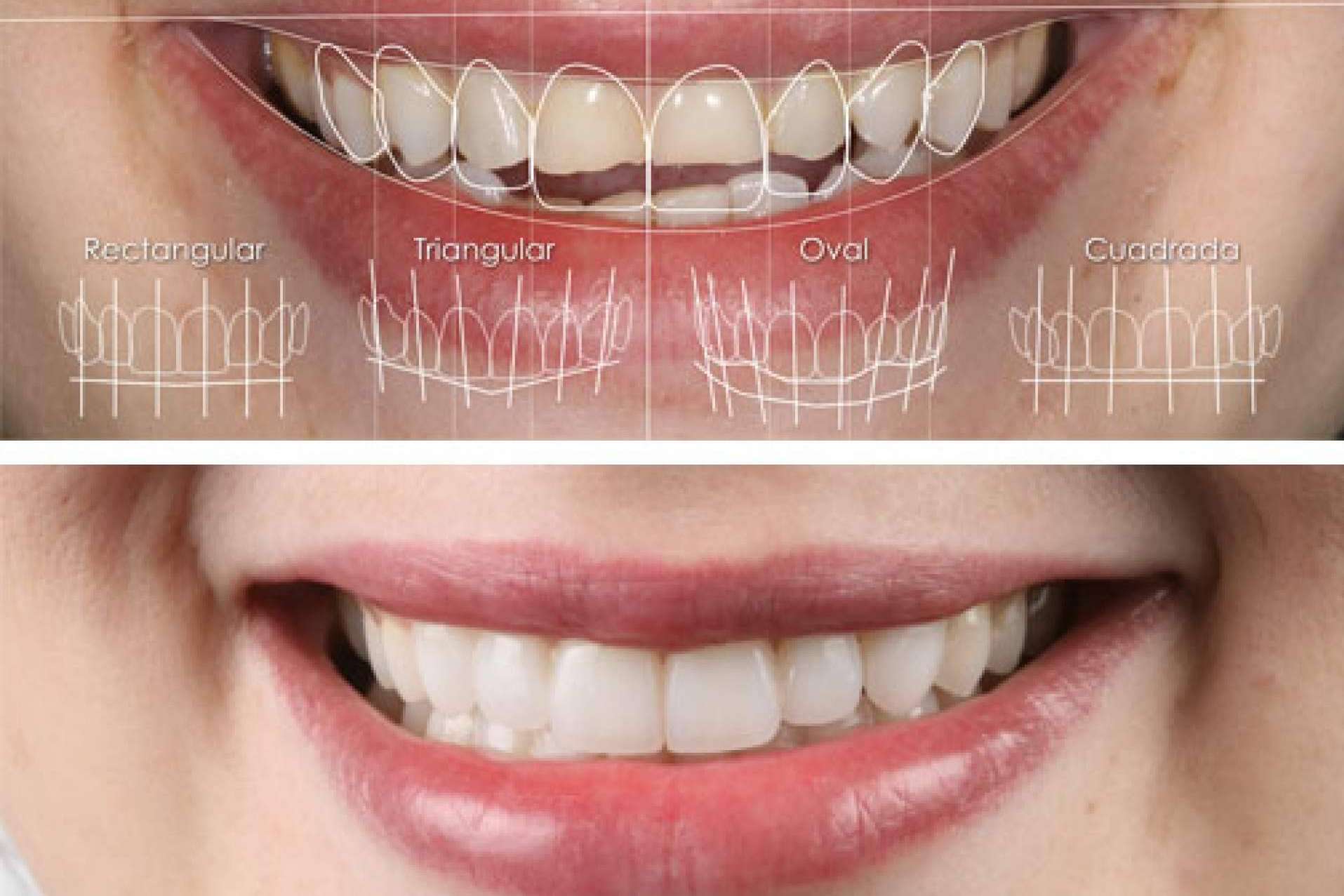 Uno de los recursos favoritos por los expertos en estética dental son las carillas dentales, según Clínica Dental Ruiz de Gopegui