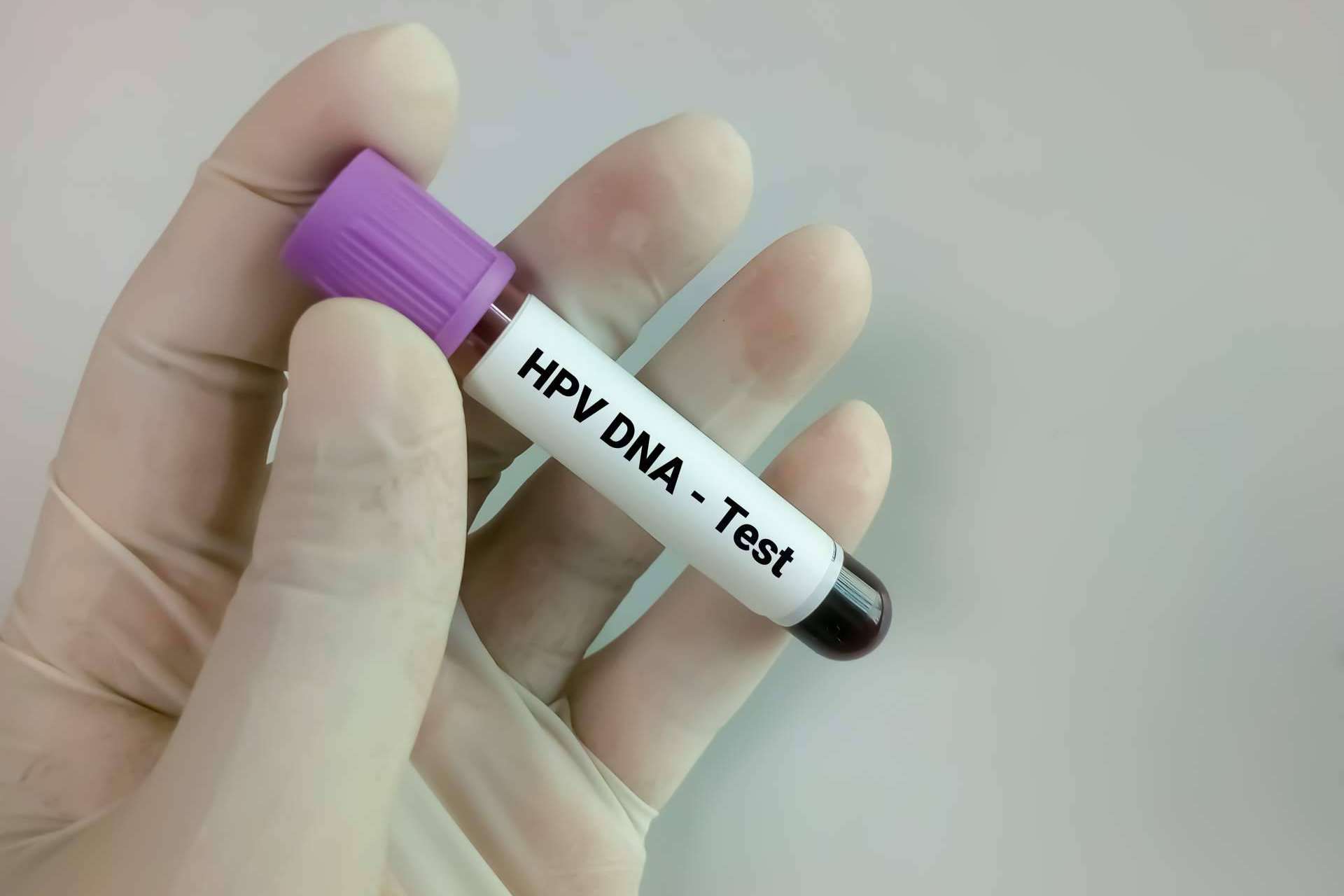 Carmen de Endosofia explica en qué consiste el virus del papiloma humano