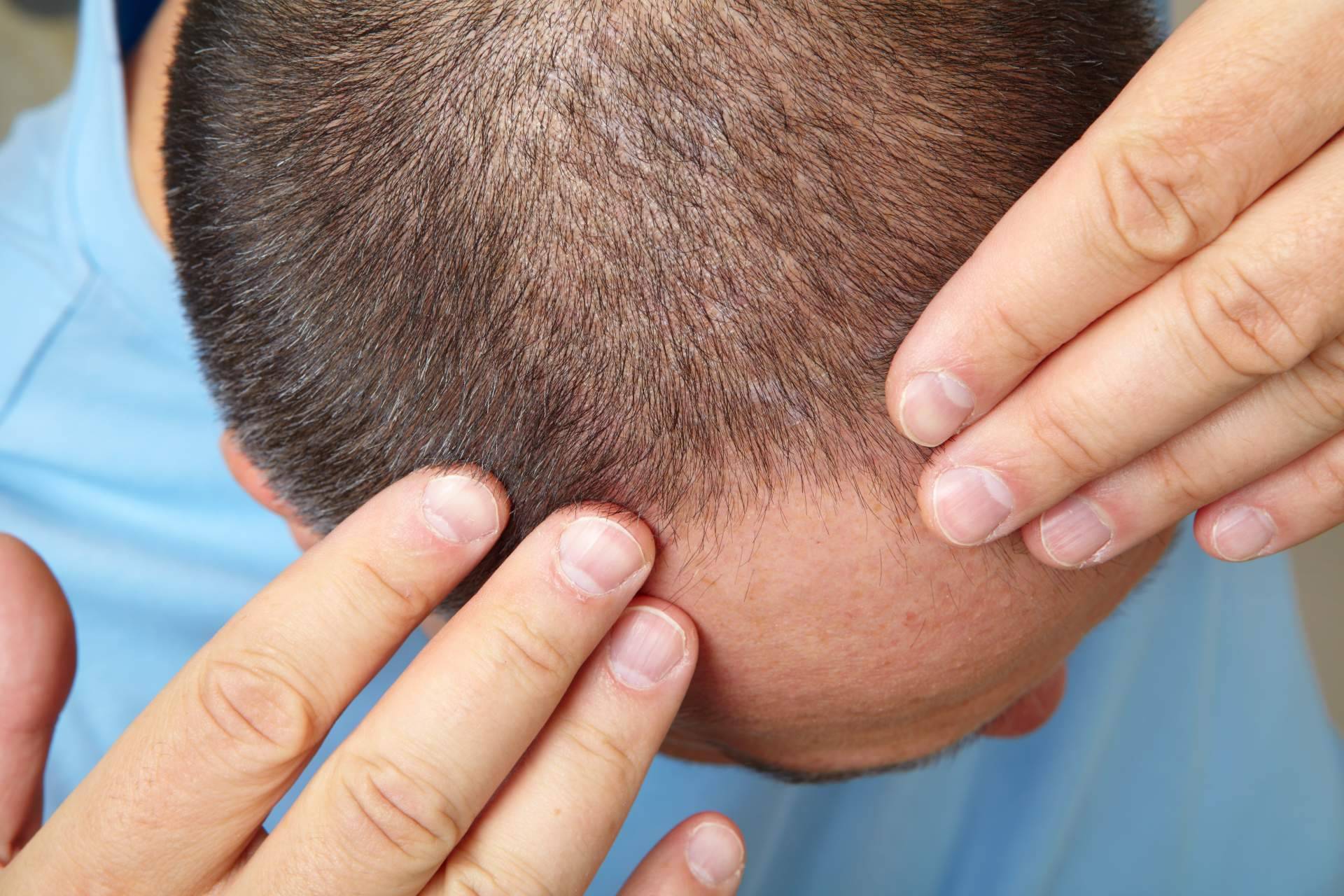 ¿Cuánto tarda en crecer el pelo después de un injerto capilar?, por MC360